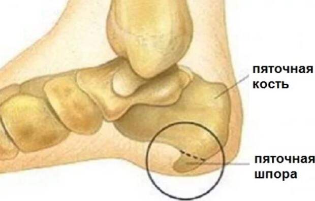 Пяточная шпора - болючий "шип" в ноге. 13 быстрых рецептов лечения, ходить будете свободно и легко!