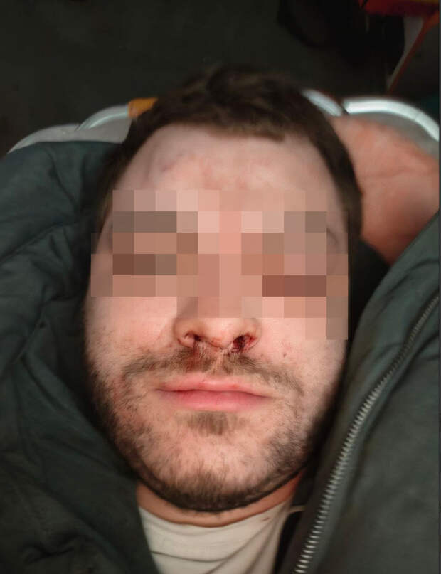Приезжие избили парня с протезами. Били ногами даже женщины. Полиция просит не раздувать