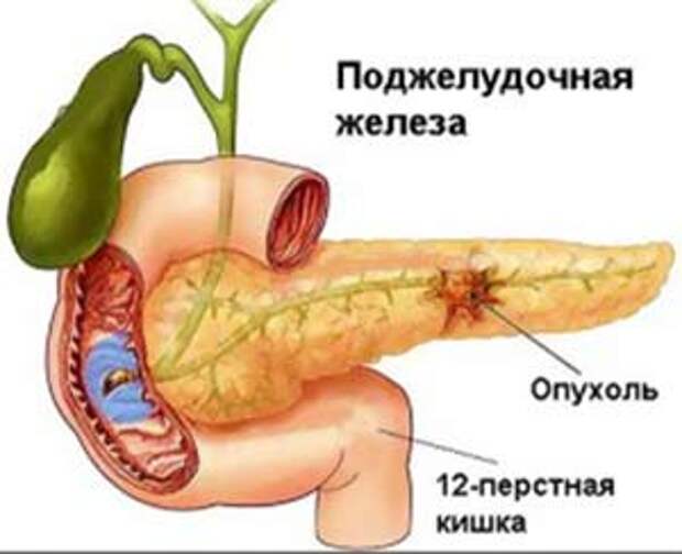 Признаки заболеваний поджелудочной