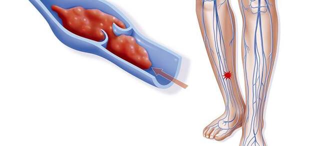 Тромбофлебит: Почему варикозное расширение вен может превратиться в смертельную угрозу. Объясняет флеболог