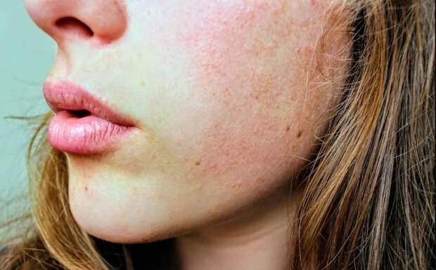 Как увлажнить сухую кожу? Советы дерматолога