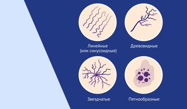 Сосудистые звездочки на лице и ногах: почему они появляются и как от них избавиться навсегда?