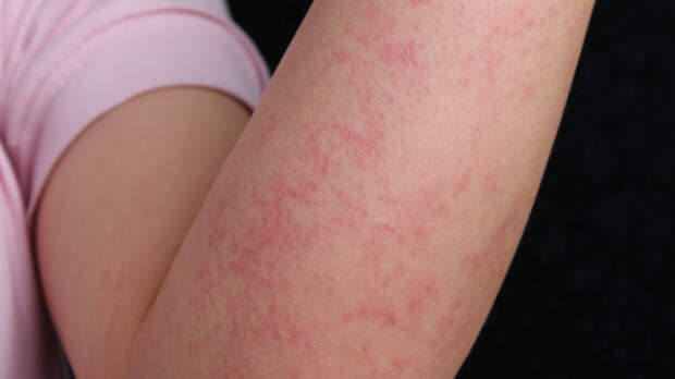 Аллергия или заболевание печени: на что указывает постоянный зуд