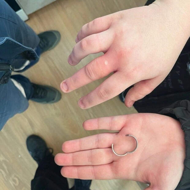 Спасатели помогли 18-летней девушке в Минусинске снять кольцо, впившееся в палец