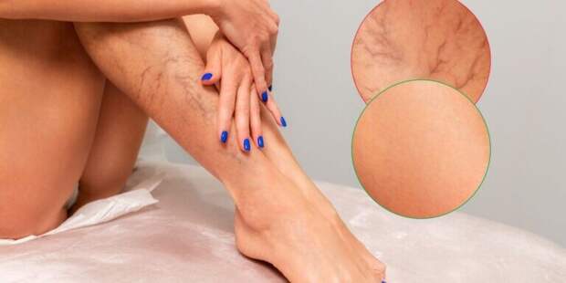 Как правильно предотвратить варикоз: советы врачей
