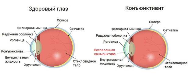 Конъюнктивит