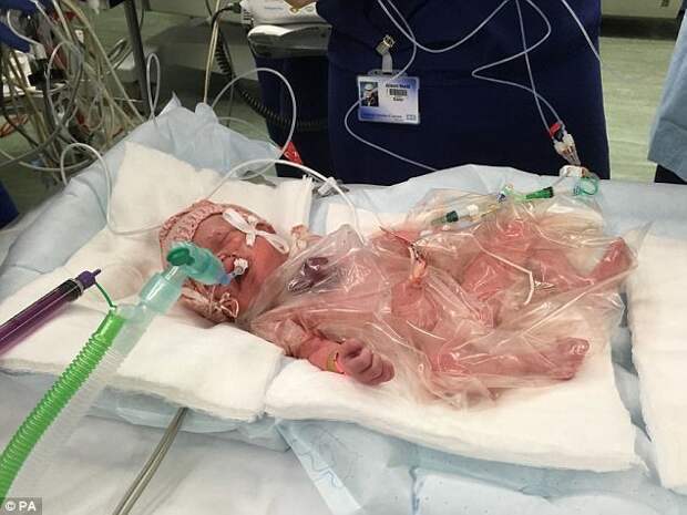 Сейчас малышка находится на искусственной вентиляции лёгких, и врачи уверены в том, что она успешно восстановится врачи, дети, младенец, новости, операция, патология, сердце, фото