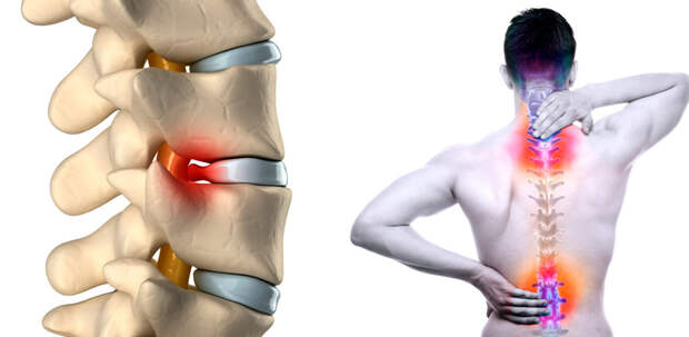Лечение межпозвонковой грыжи: современные подходы В Тюмени
