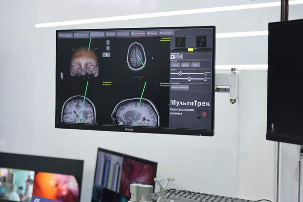В Петербурге создали нейросеть для выявления гематом мозга