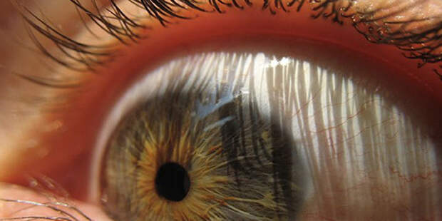 Глаза По сути, организм не воспринимает глазные яблоки как свою неотъемлемую часть. Поэтому они ограничены специальным аутоиммунным барьером. Если бы его не было, белые клетки крови с глазами быстро управились.