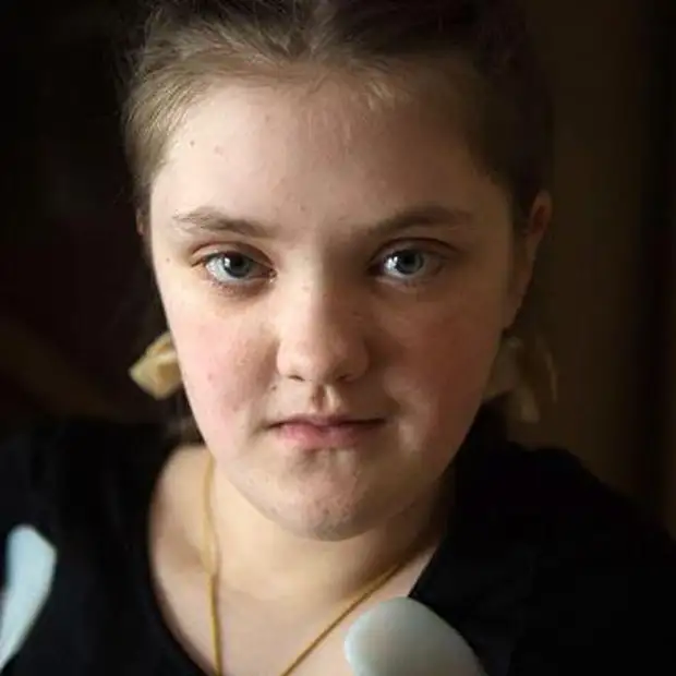 Арина Акимова, 15 лет, грудопоясничный сколиоз 4-й степени, спасет операция, 743 183 ₽