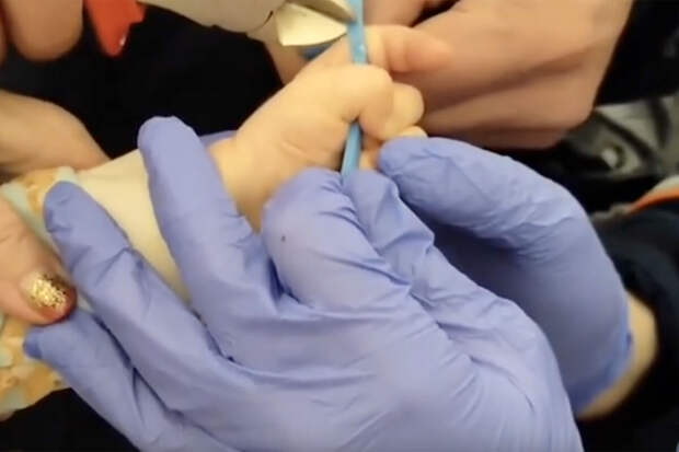 В Новосибирске спасли младенца, застрявшего пальцем в ложке