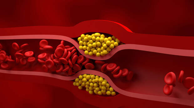 Кардиолог Каневская: атеросклероз часто встречается у курильщиков