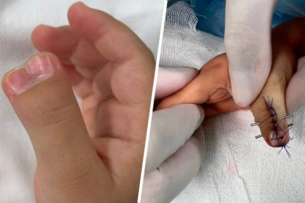 В Подмосковье врачи удалили сдвоенный палец годовалому ребенку