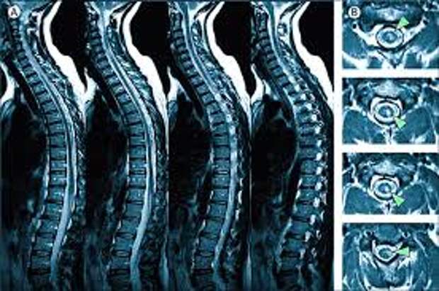 Роль МРТ в диагностике заболеваний позвоночника