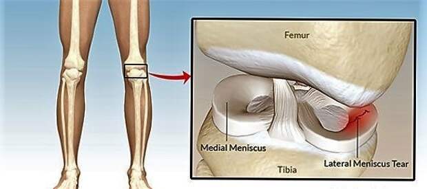 Что такое мениск и из-за чего он может повредиться: диагностика, лечение и реабилитация