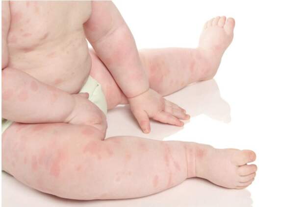 JAMA: развитие пищевой аллергии у детей зависит не только от генетики