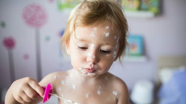 Ветрянка у детей: чем опасна и как не заразиться