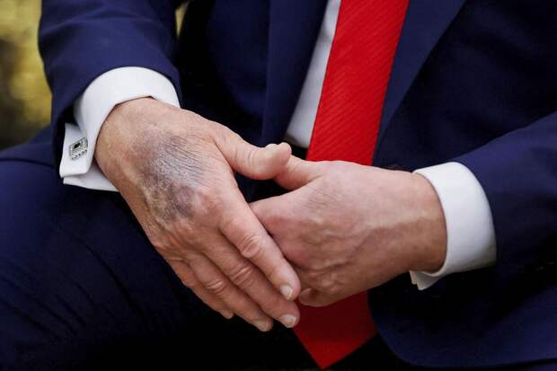 Трамп заявил, что синяк на его руке из-за пагубного влияния аспирина