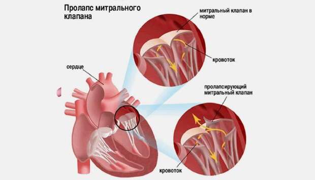 Пролапс митрального клапана и норма