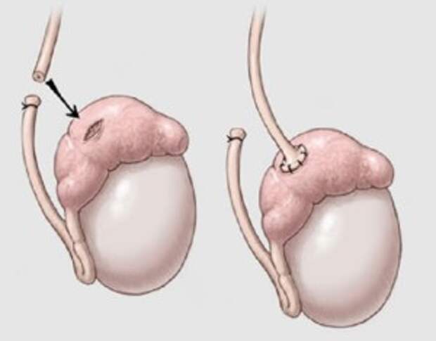 Почему болят яйца у мужчины. Хирургическая стерилизация вазэктомия. Вазэктомия оперативные вмешательства. Гидатида яичка операция.