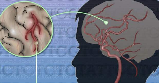 Исследование: недавние инфекции часто предшествовали детским и подростковым инсультам