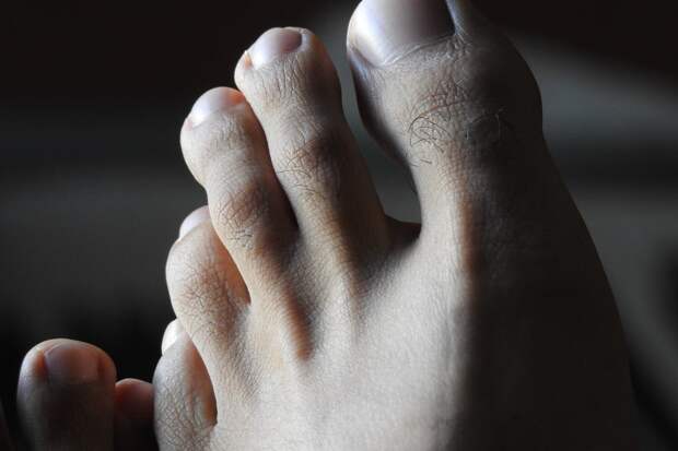 Симптом высокого холестерина, который поражает стопы — признак закупорки бляшками