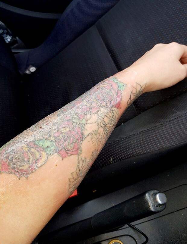Невеста горько пожалела о решении удалить татуировку лазером перед свадьбой