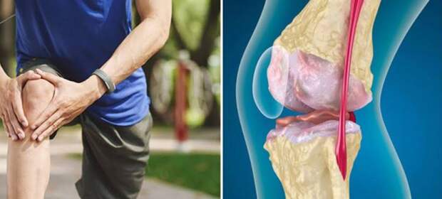 Остеоартроз