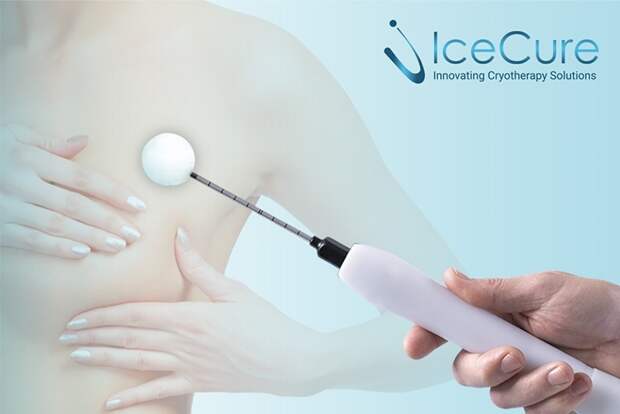 "Ледяной удар" по раку: как израильская технология замораживания опухолей меняет правила игры в онкологии