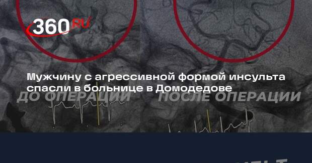 Мужчину с агрессивной формой инсульта спасли в больнице в Домодедове