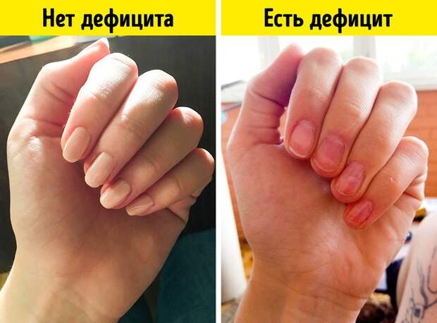 Признаки дефицита витамина С