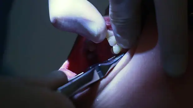 Стоматолог предупредила об опасности потери зубов из-за стресса