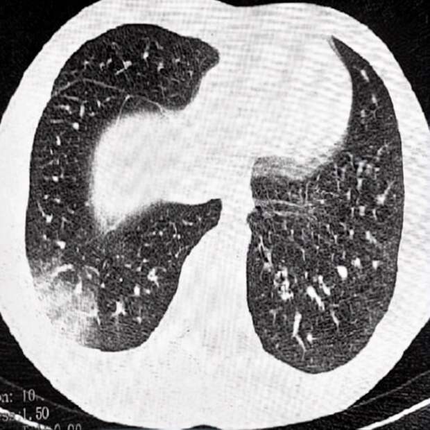 Троих подростков с «попкорновой» болезнью лёгких экстренно увезли в реанимацию в