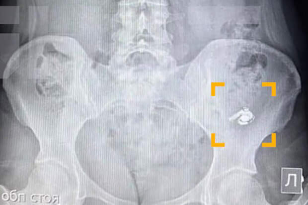 Life.ru: жительница Уфы проглотила наушник AirPods из-за его схожести с таблеткой