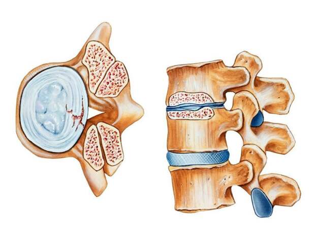 Протрузия дисков
