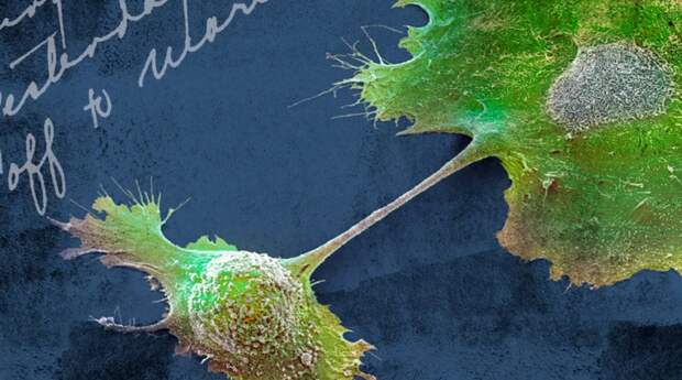 Клетки рака поджелудочной железы (зеленого цвета на синем цвете)