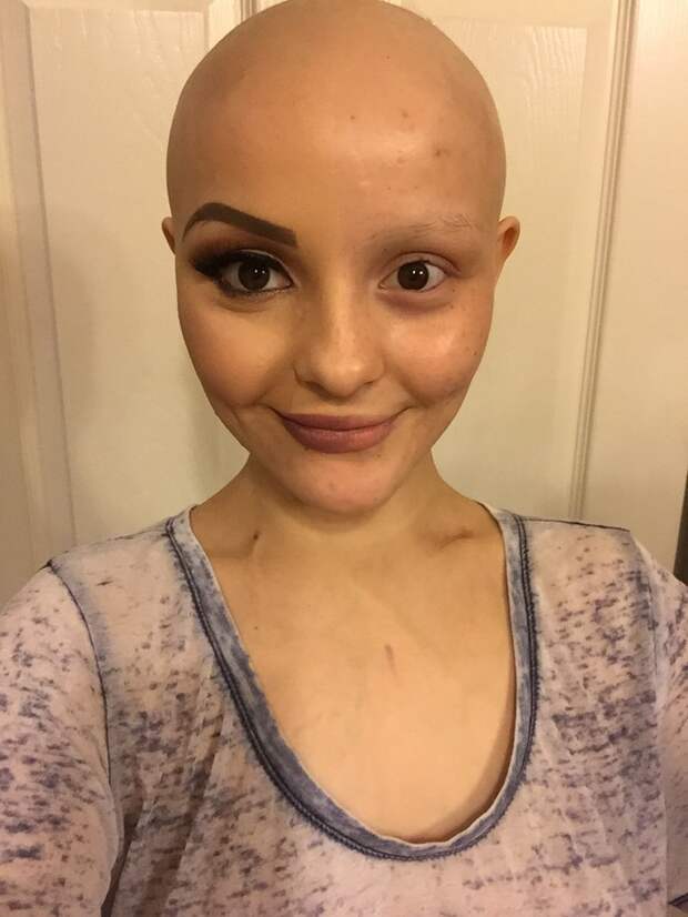 Спустя год после потери волос из-за рака, девушка вернулась и она полностью преобразилась болезнь, в мире, волосы, девушка, лечение, люди, рак, сила воли
