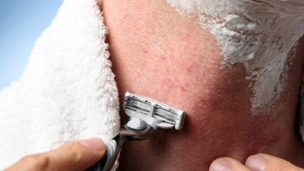 7 верных и простых способов избавиться от раздражения после бритья