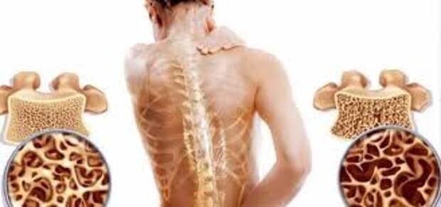 Комплексный подход к лечению остеопороза позвоночника