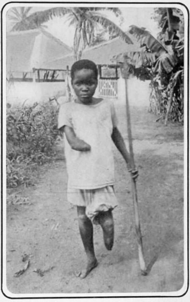 17. Мальчик, изуродованный бельгийскими солдатами в Конго, 1905 год век, мир, прошлое, снимок, событие, странность, фотография
