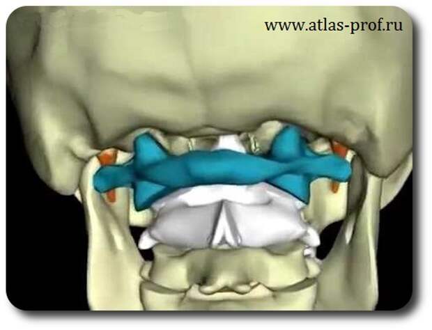 Смещение атланта у детей фото