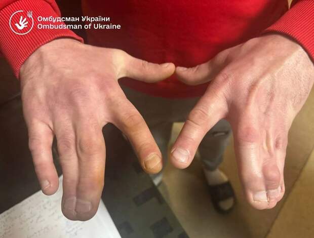 На Украине мобилизовали мужчину со сросшимися на руках пальцами