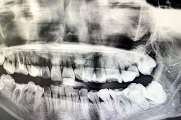 Врач Кузьмин: плохая гигиена может вести к истончению кости вокруг зубного импланта