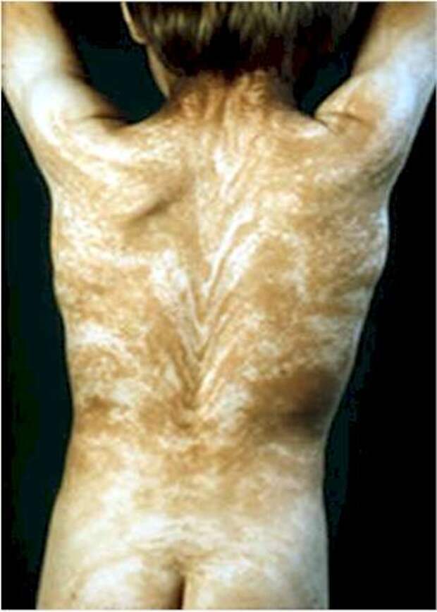 Линии Блашко: характеризуется странными полосами по всему телу