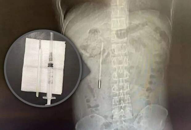 20 лет жил с градусником в животе, потому что боялся всем об этом рассказать