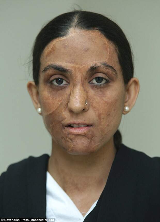 24-летняя уборщица Захида Парвин обожгла лицо газом на собственной кухне. врачи, жертвы насилия, кислота, кислотная атака, медицина, пластическая операция, трансплантация, фото