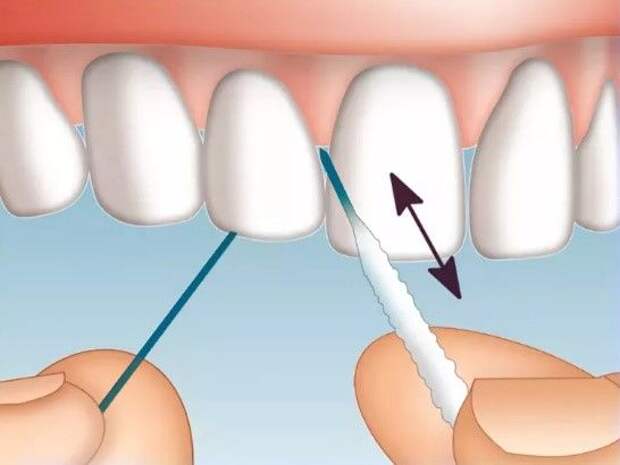 Зубная нить супер-флосс для брекетов, имплантов, мостовидных протезов, ретейнеров. Купить