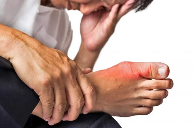 Ревматолог Самкова объяснила, как избежать подагры