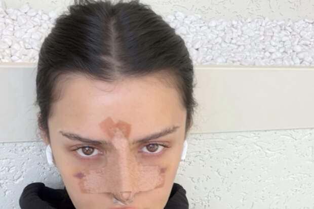Блогерша Дина Саева опубликовала фото после ринопластики